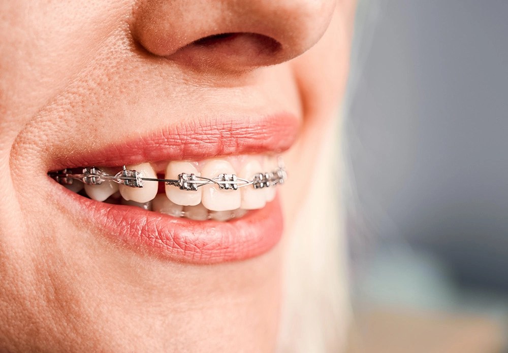female-smile-with-wired-braces-on-teeth-